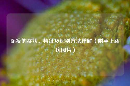 跖疣的症状、特征及识别     详解（附手上跖疣图片）